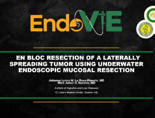 EN BLOC RESECTION OF A LATERALLY SPREADING TUMOR USING UNDERWATER ENDOSCOPIC MUCOSAL RESECTION